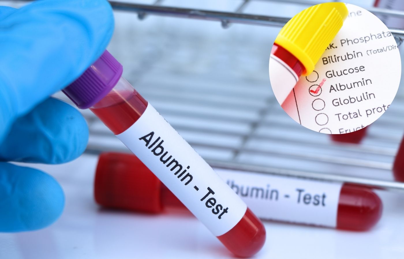 Albumin Test 